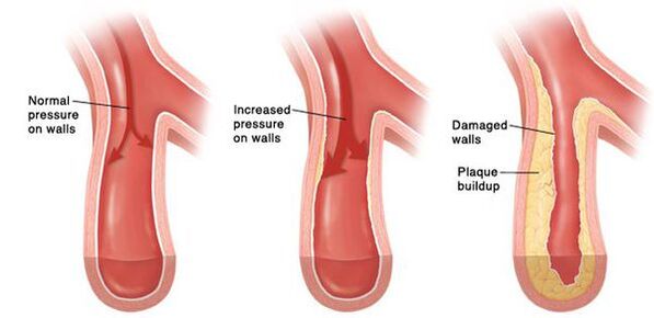 In hypertension, there is a violation of the patency of the vascular bed